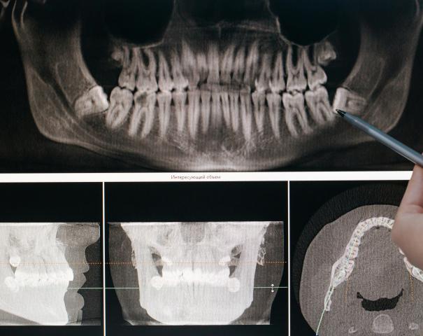 Angel Aligner