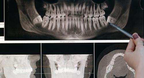 Angel Aligner